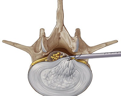 Endoscopic spine discectomy