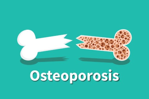 osteoporosis 1 -01