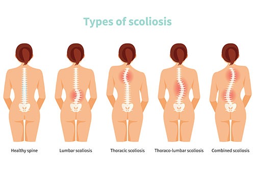 scoliosis-2