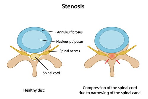 spinal-stenosis-2