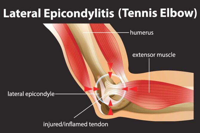ALL YOU NEED TO KNOW ABOUT TENNIS ELBOW/LATERAL EPICONDYLITIS