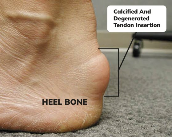 Achilles Tendonitis