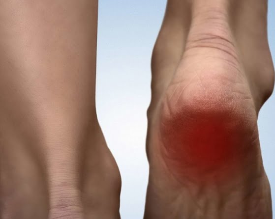 Policeman's heel deals symptoms nhs