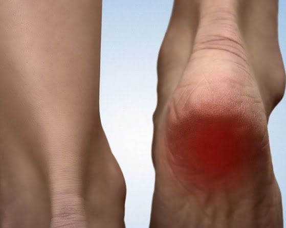 Complete Heel Pain Guide: Diagnosis & Treatment | KURU