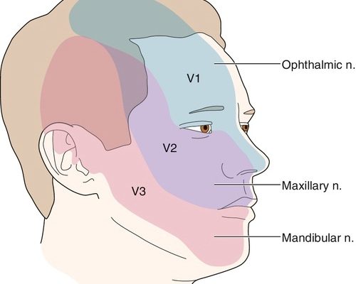 Trigeminal neuralgia (TN) is defined by recurrent unilateral brief