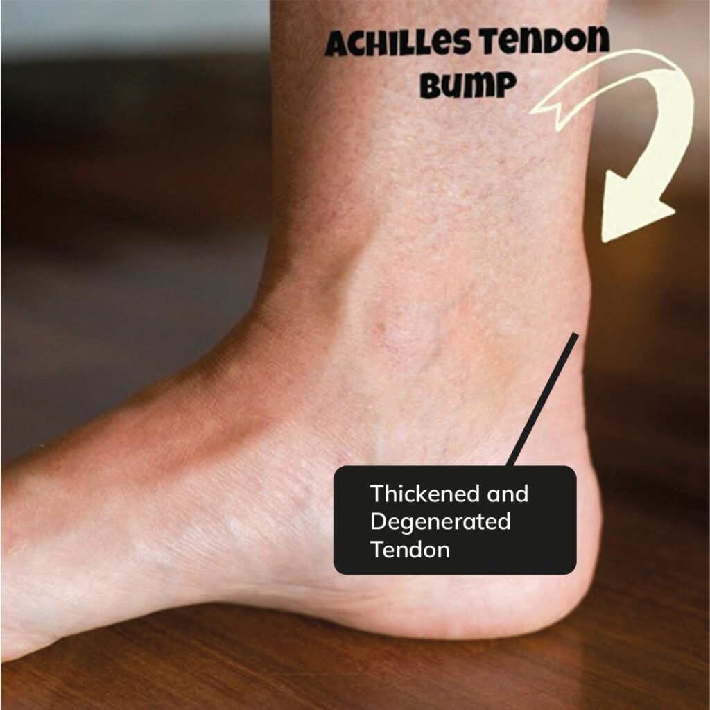 Achilles tendinitis - Wikipedia