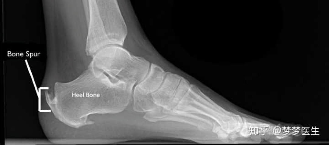 Achilles tendon on sale calcification treatment