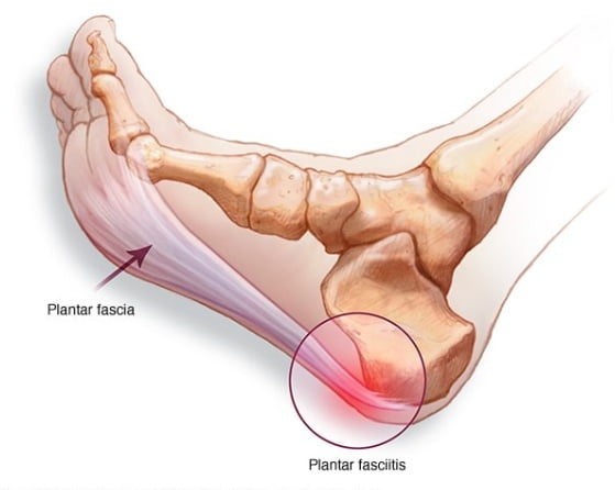 Plantar Fasciitis Introduction