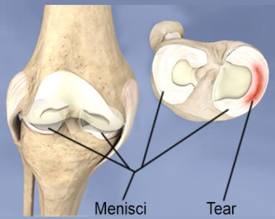 Meniscal Tears