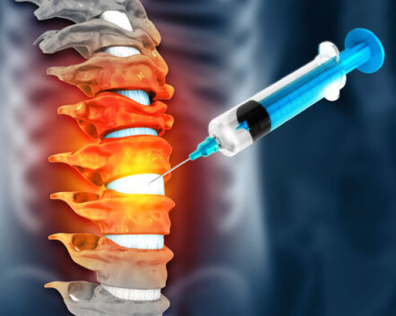 A Ray of Hope: Injection-Based Treatment for Low Back Pain