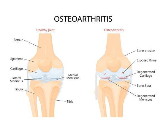 Osteoarthritis of the Knee : Causes, Symptoms, Investigations, and Non-Surgical Injection- Based Treatment