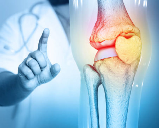 10 Effective Nonsurgical Treatments for Knee Arthritis: Evidence-Based Solutions for Pain Relief and Improved Function