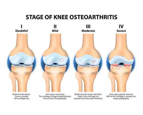 Understanding Osteoarthritis of the Knee : Etiopathogenesis, Epidemiology, Radiological Features, and Pain Generators