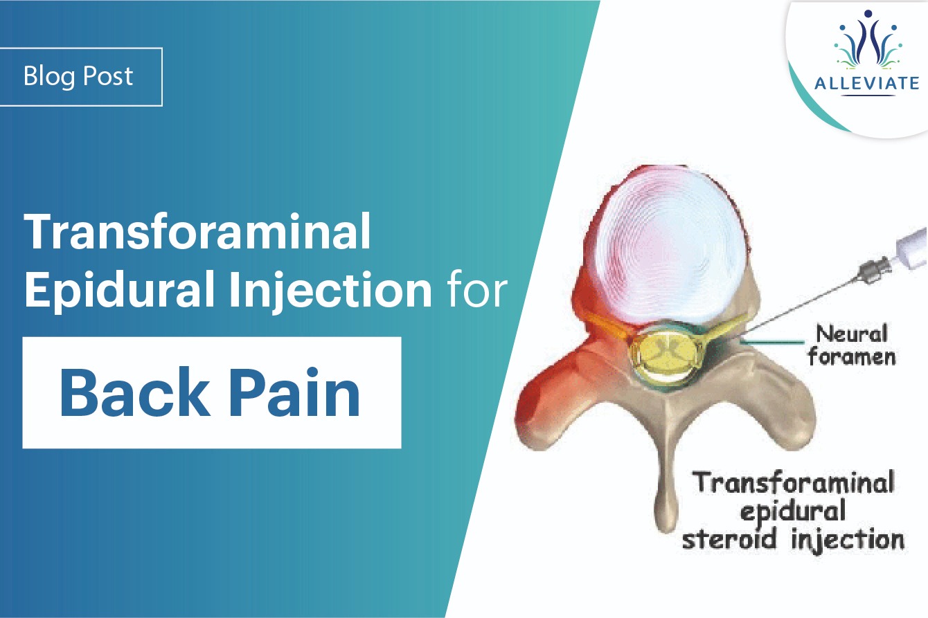 <span>Transforaminal Epidural Injection for Back Pain</span>