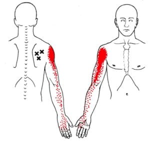 trigger points5