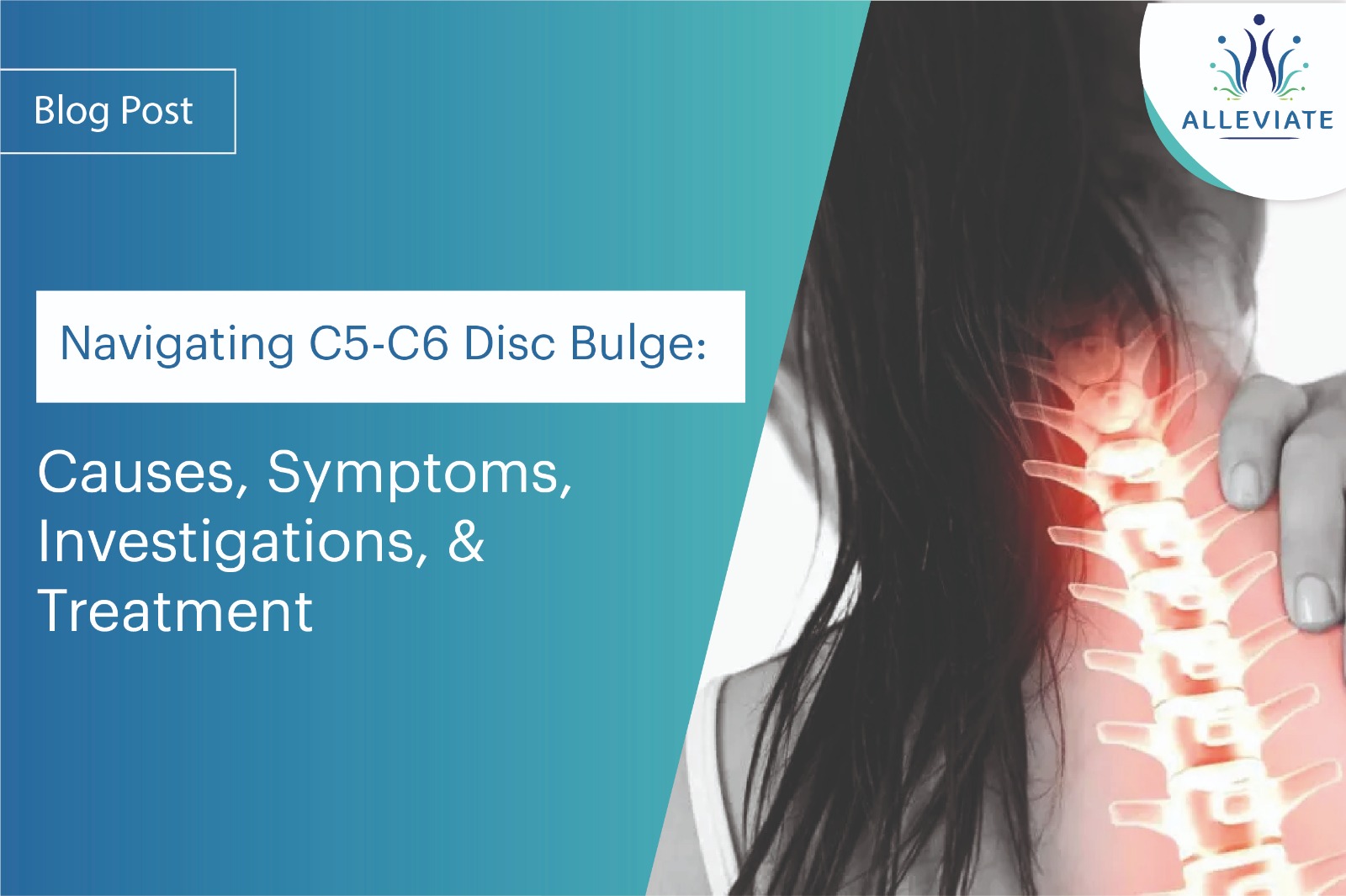 <span>Navigating C5-C6 Disc Bulge: Causes, Symptoms, Investigations, and Treatment</span>