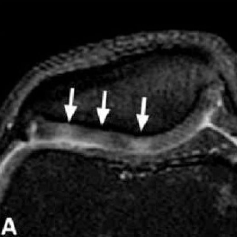Knee pain management strategies Knee pain doctor Bengaluru