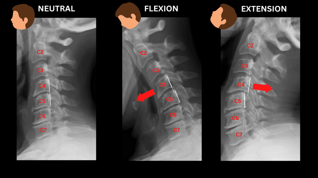 Neutral flexion extension