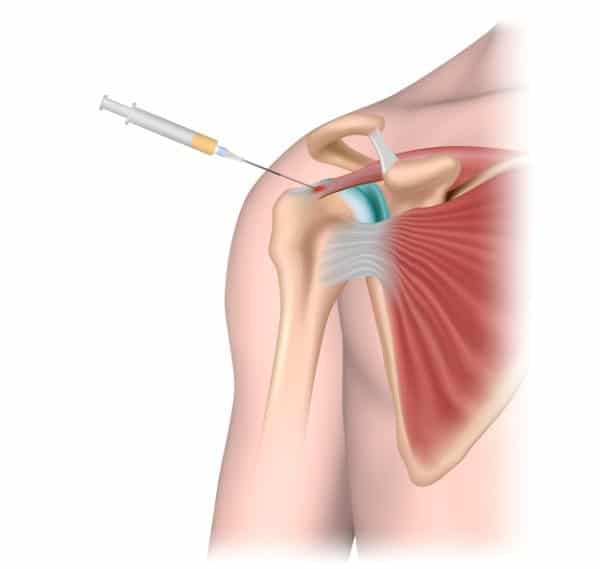 Clinical Results and Efficacy of PRP Treatment In Rotator Cuff Pathologies