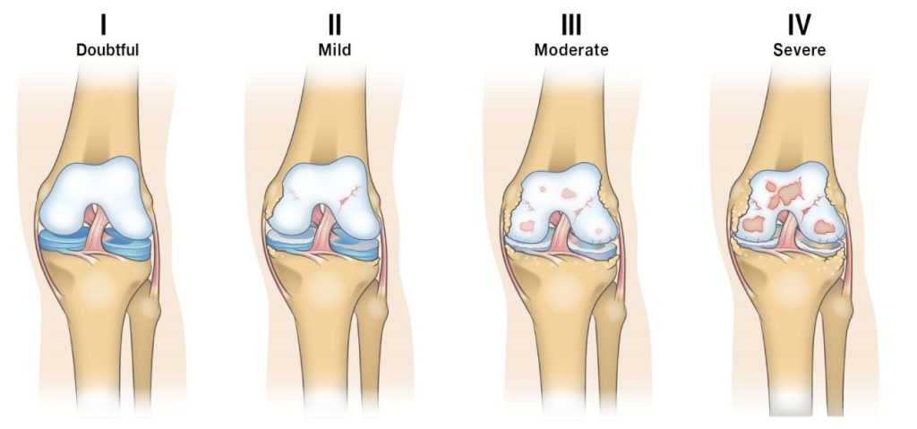 Knee Arthritis: An Overview