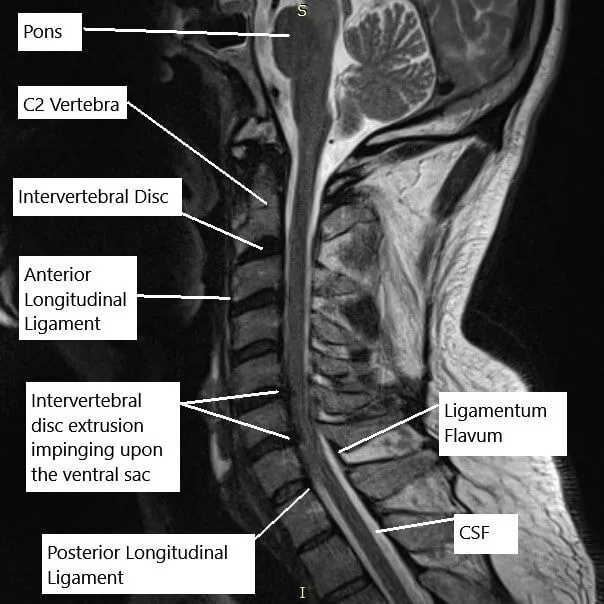 Role of MRI in Diagnosis