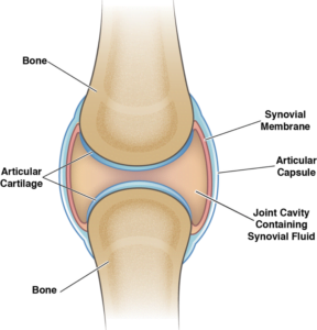 Cartilage Loss/Joint Space Narrowing