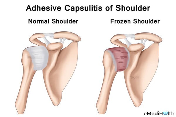 adhesive capsulitis