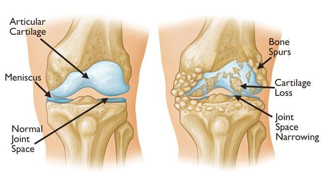 Understanding Severe Knee Osteoarthritis