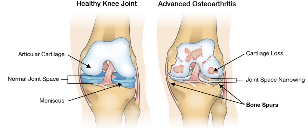 Osteophyte Formation