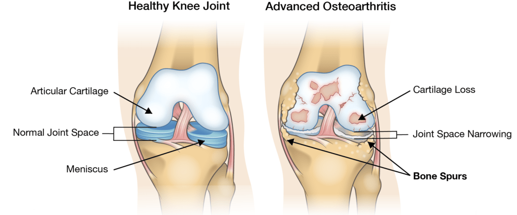 Osteophyte Formation