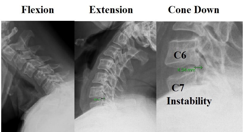 Diagnosis of Cervical Instability