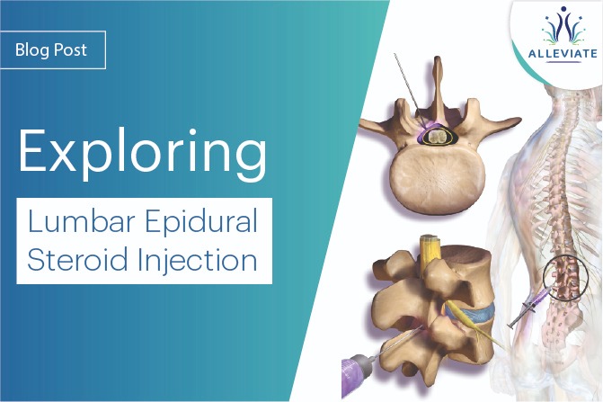 <span>Exploring Lumbar Epidural Steroid Injection</span>