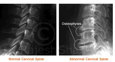 Abnormal Cervical spine