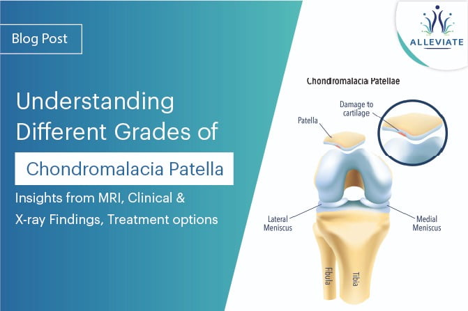 <span>Understanding Different Grades of Chondromalacia Patella: Insights from MRI, Clinical and X-ray Findings, Treatment options</span>