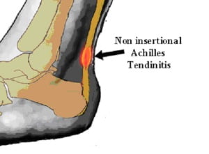 Achilles on sale insertional tendinitis