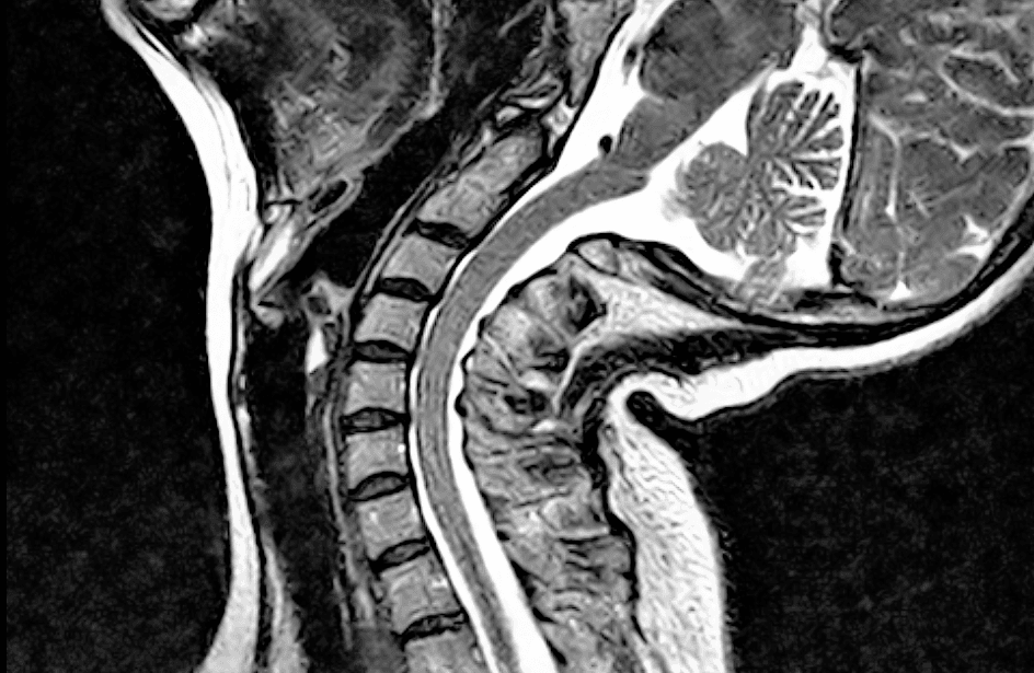 What is Craniocervical Instability(CCI)? Effective Treatment Options