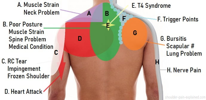 Shoulder Pain - Symptoms and Causes