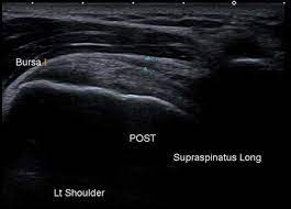 Supraspinatus long