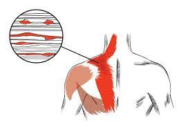 Trigger points in the trapezius muscle